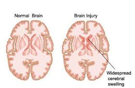 Causes of Head Injury or Traumatic Brain