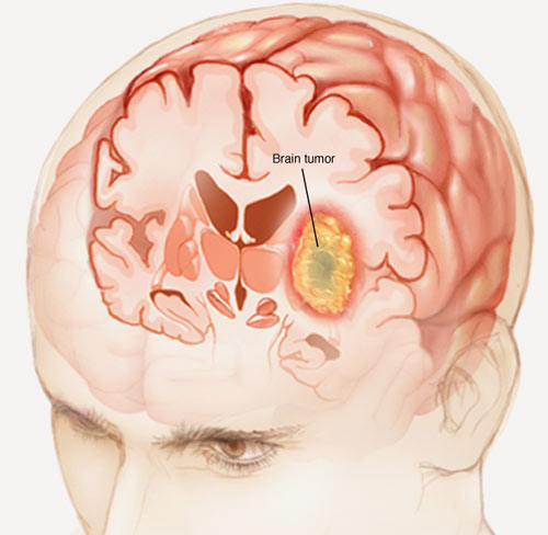 Treating tumors in the base of the skull