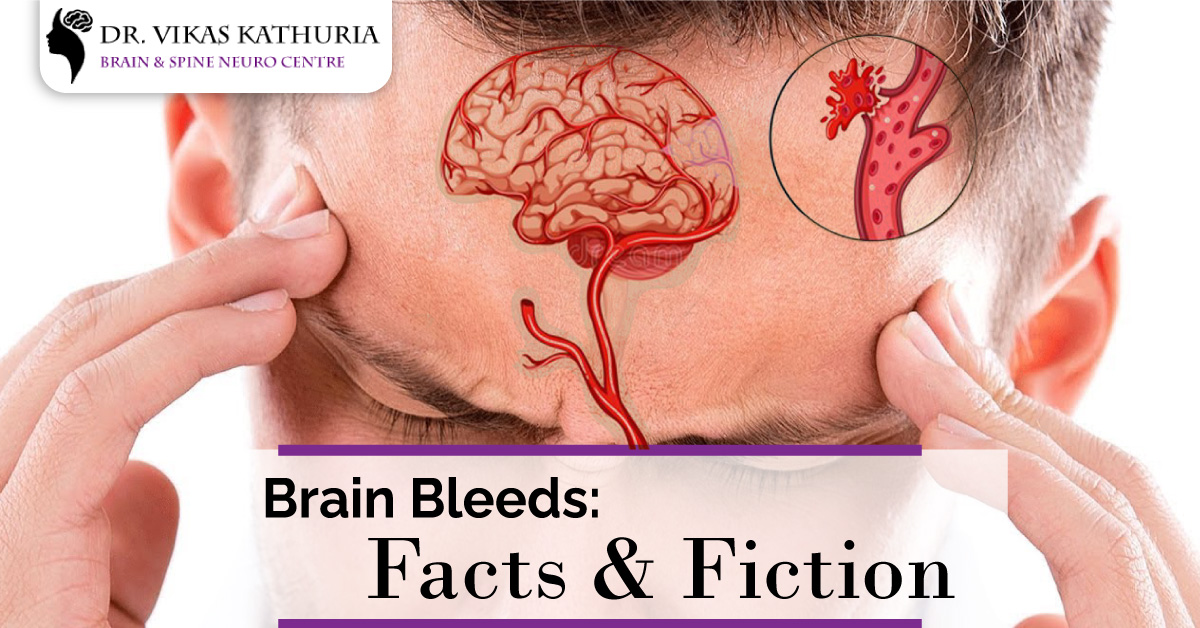 Brain Bleeds: Facts and Fiction