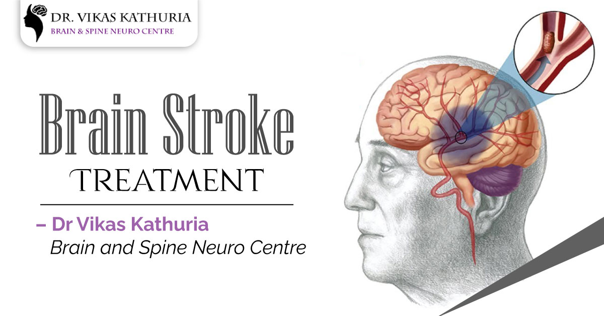 Brain Stroke Treatment