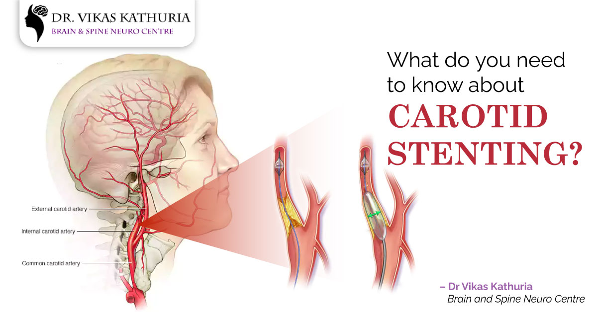 What Do You Need To Know About Carotid Stenting?