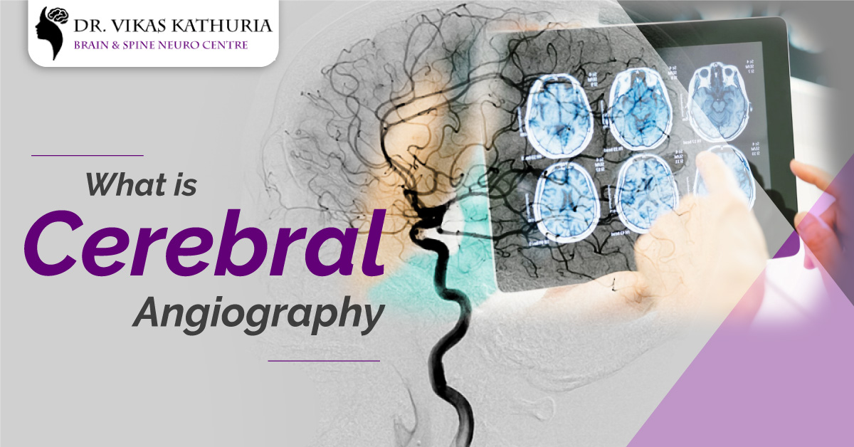 What is Cerebral Angiography