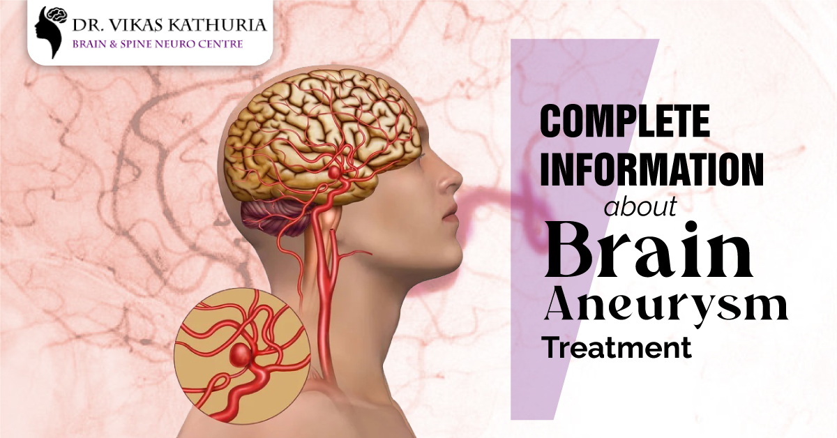 Complete Information About Brain Aneurysm Treatment