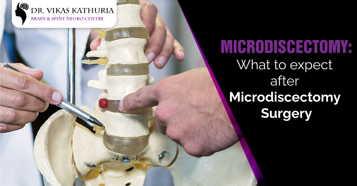 Microdiscectomy: What to Expect After Microdiscectomy Surgery