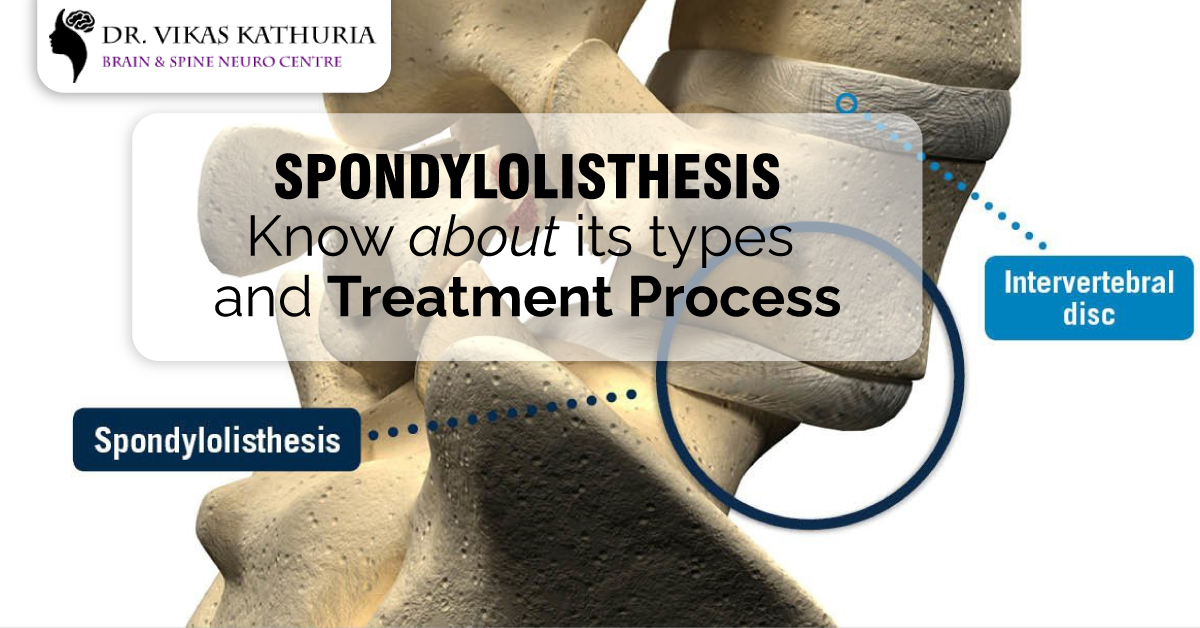 Spondylolisthesis – Know About Its Types And Treatment Process