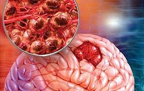 Best Neurosurgeon in Gurgaon