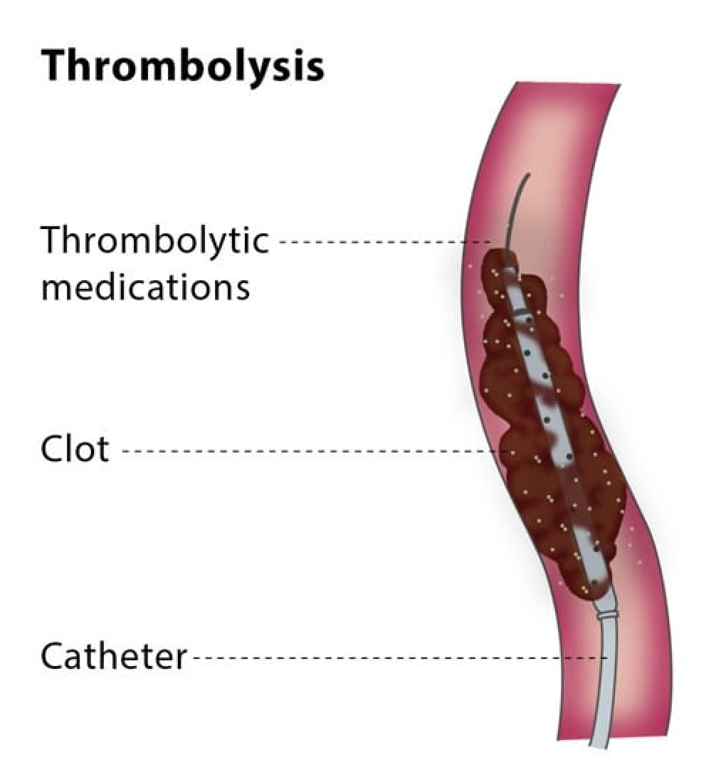 Thrombolytic Therapy in Gurgaon